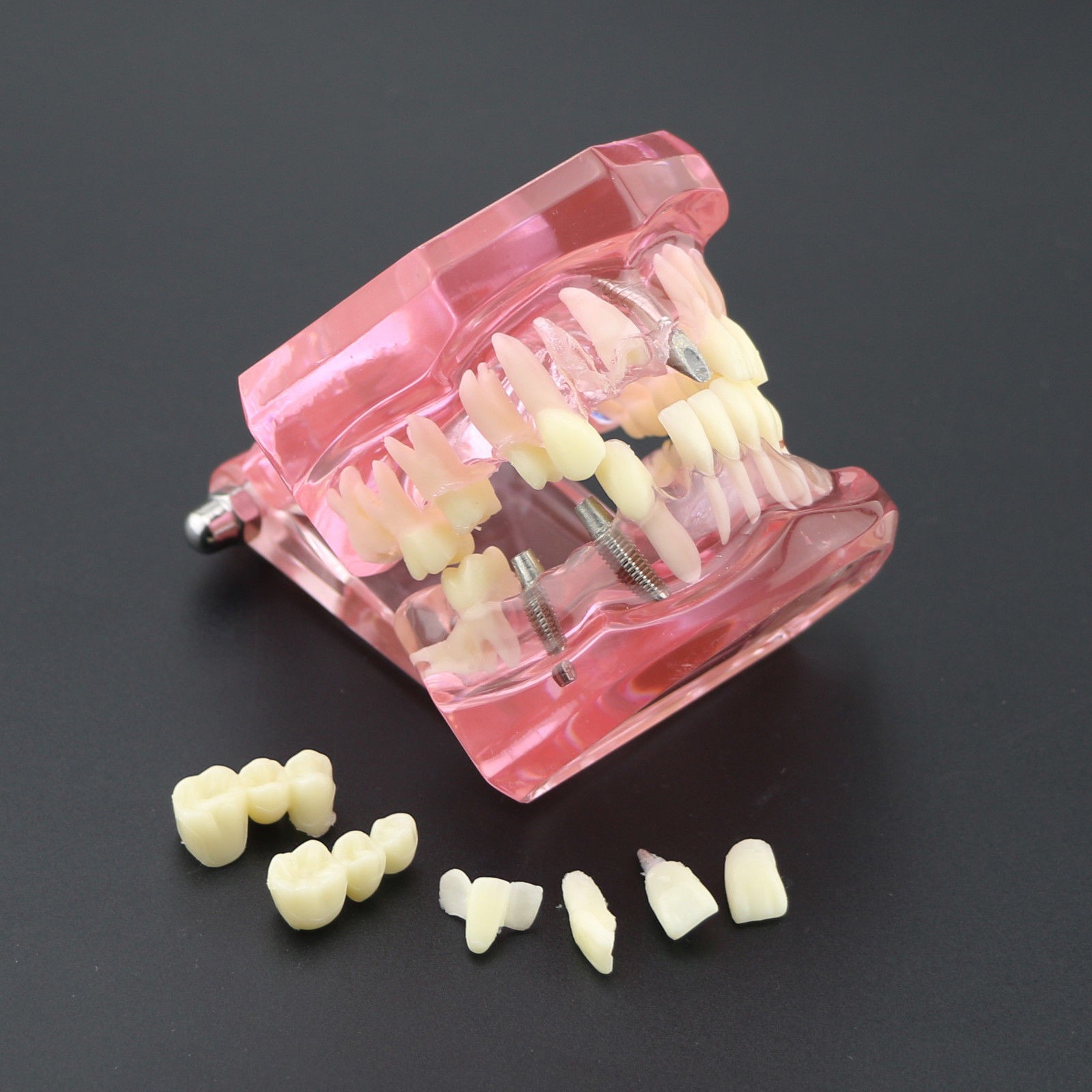 Dental Implant Teeth Model Teach Study Demo Restoration Pathology #2001 Pink