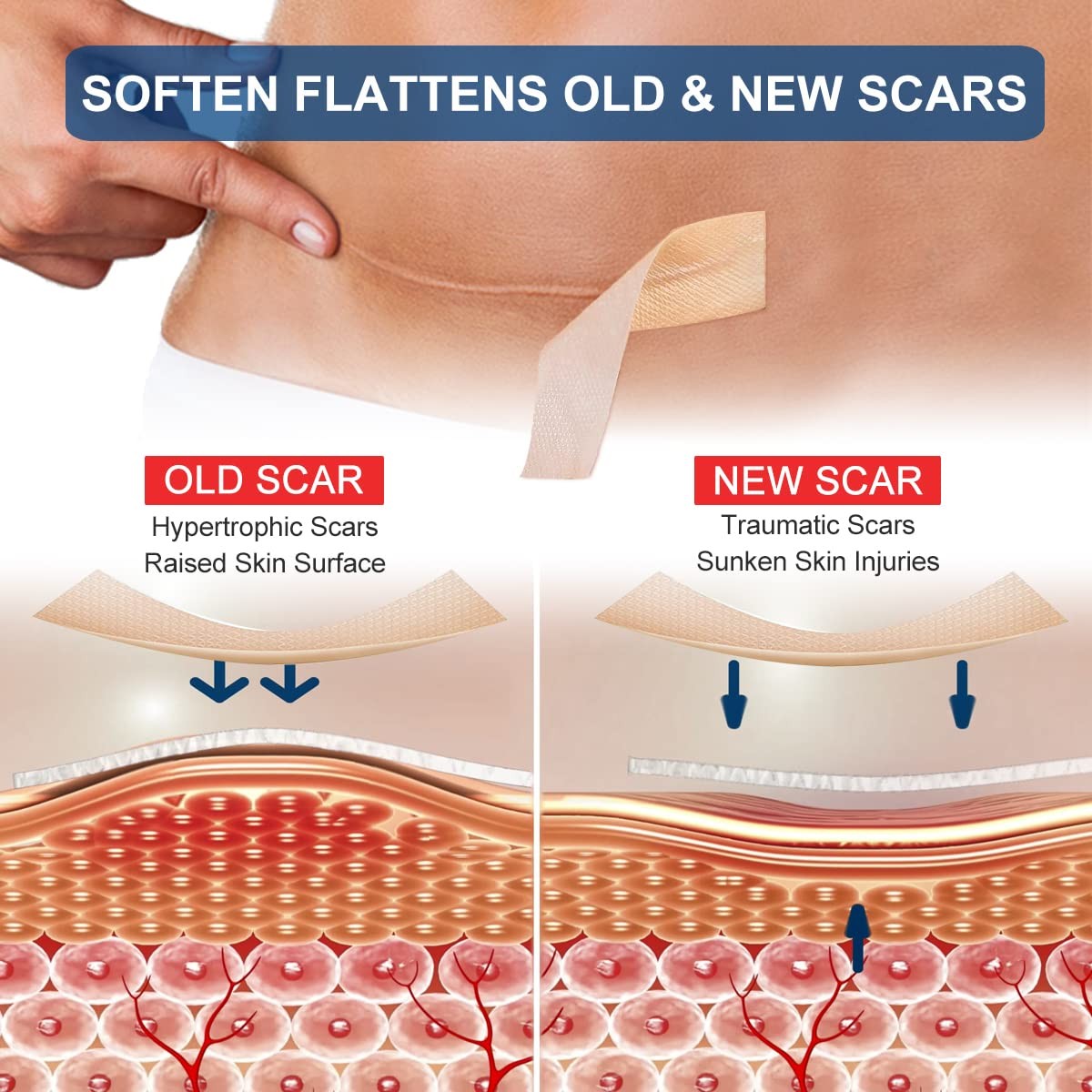 Silicone Scar Sheets (1.6” x 120” Roll-3M), 120×1.6 Inch (Pack of 1), Brown