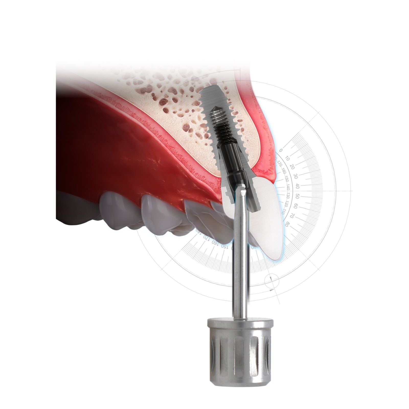 US Implant Angulated Screw Channel Screwdriver For Hiossen Nobel ITI MIS Implant