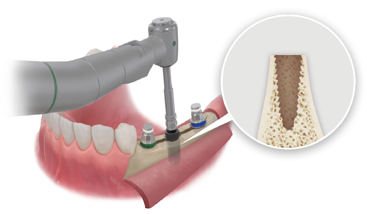 Dental Implant ESSET Kit Easy Split & Expansion of Narrow Ridge HIOSSEN OSSTEM