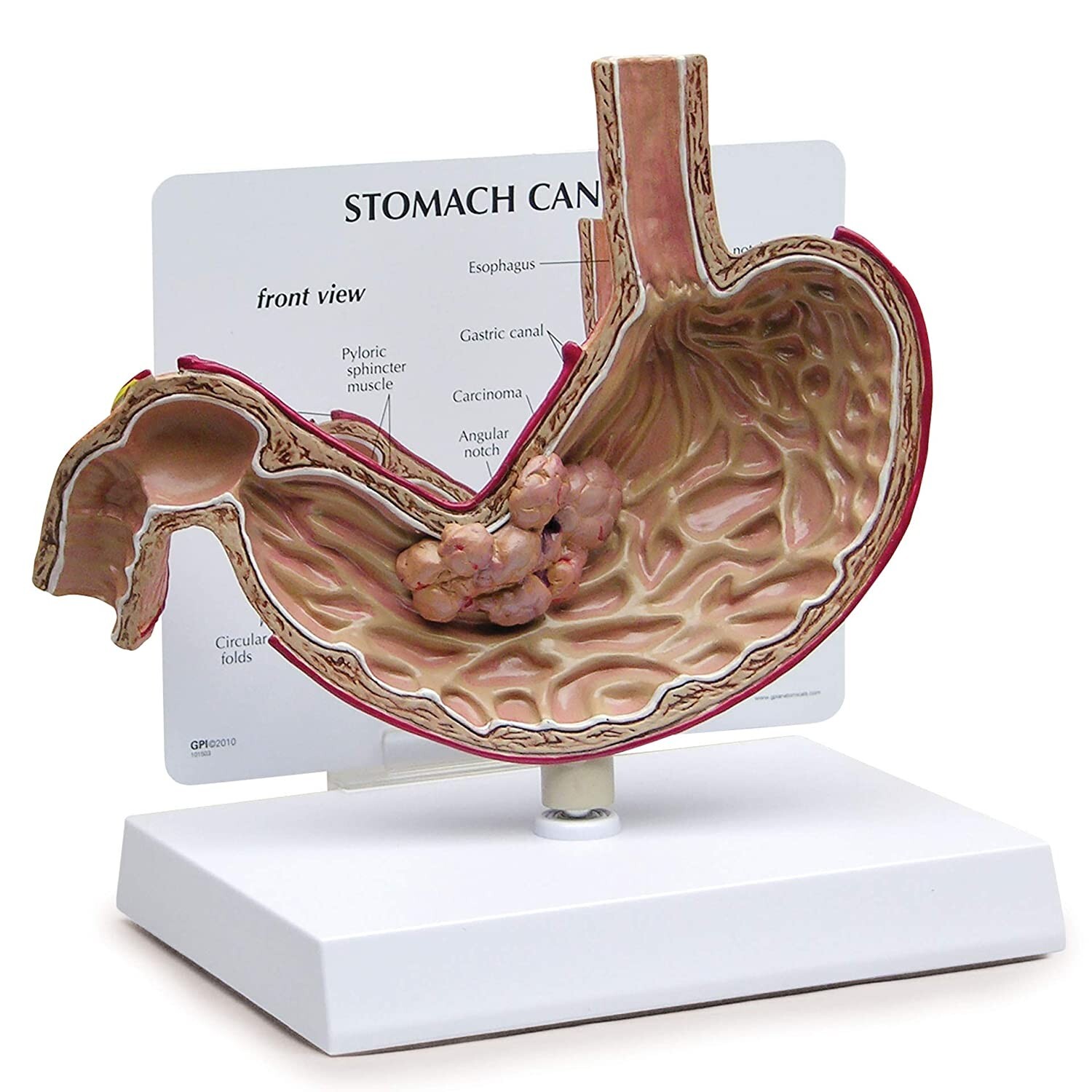 GPI #2001 – Medical/Educational Human Stomach Cancer Anatomical Model