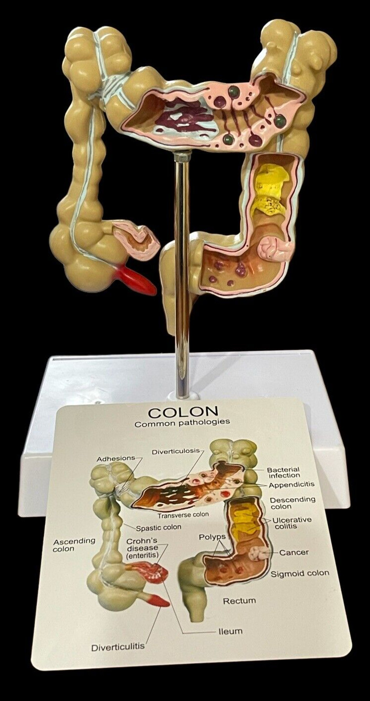 Colon Anatomy Model W Pathologies Medical Human Large Intestine 7.75″ x 6″