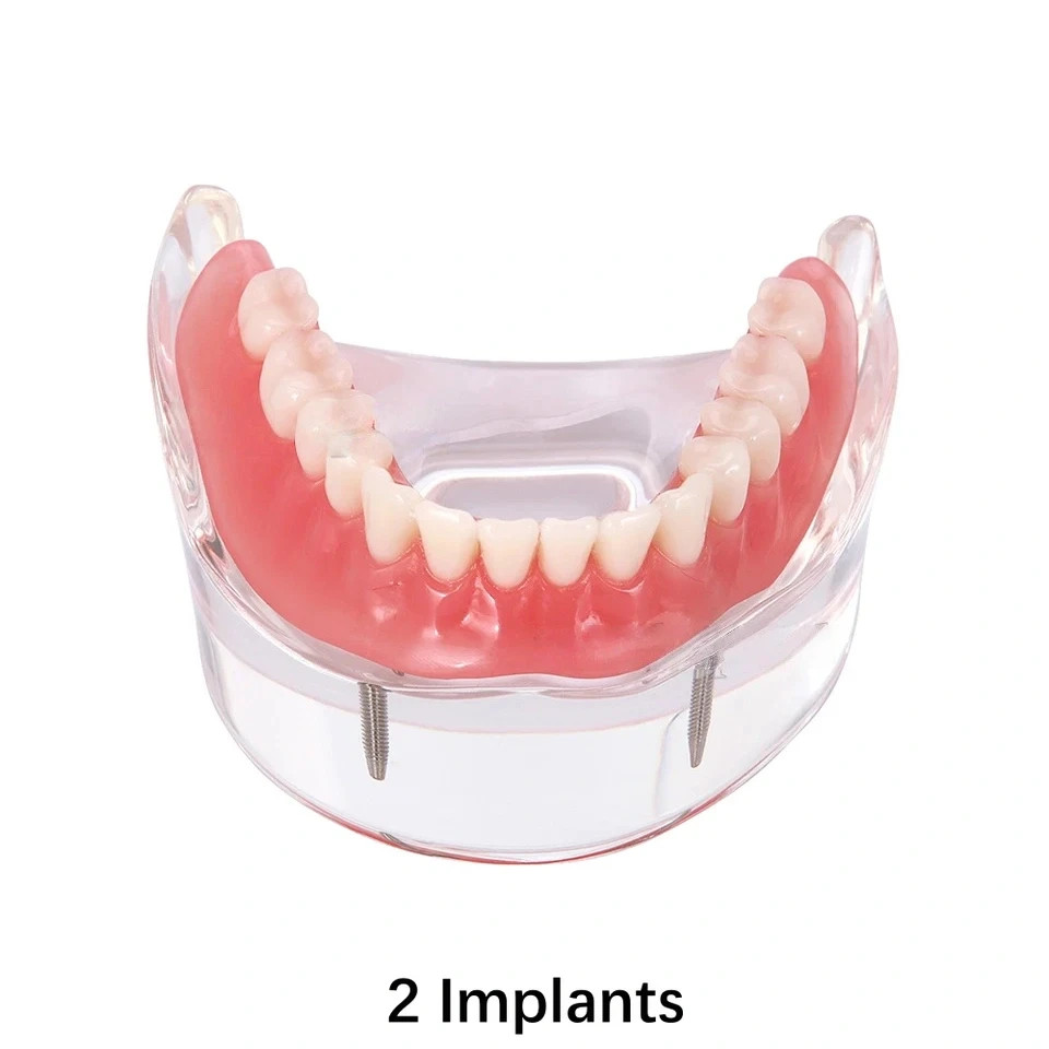 Dental Implant Teeth Model Demo Overdenture Restoration With 2 4 Implants M6002