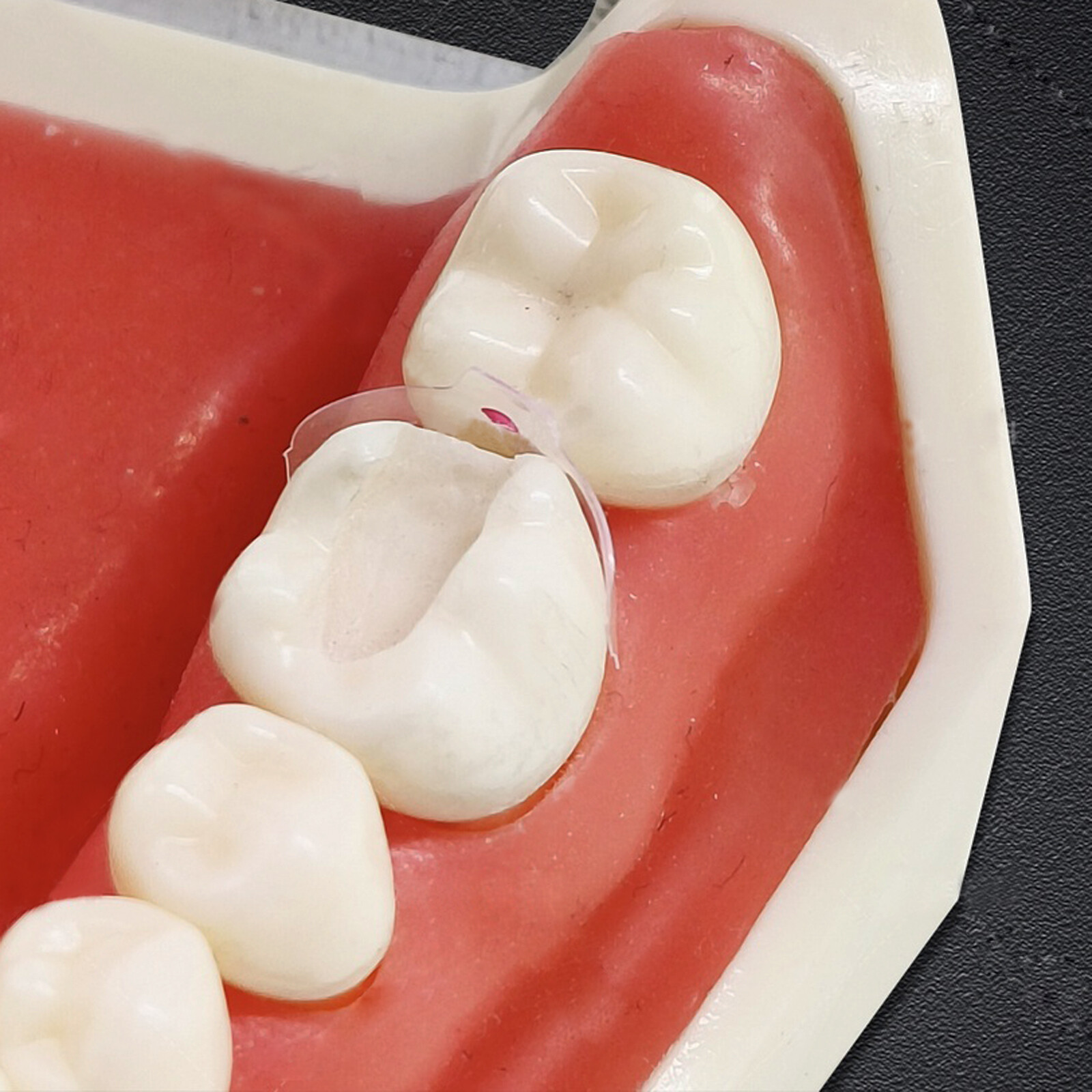 Dental Clear Matrix Anterior Posterior Restorative BT Bow Matrices Fit BioClear