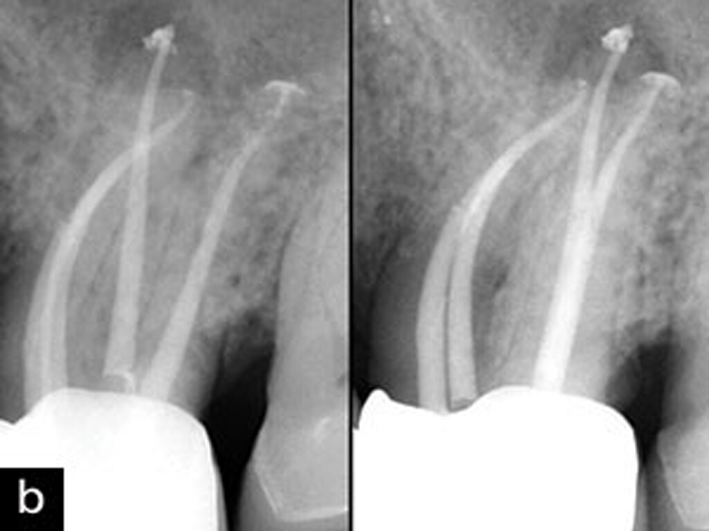 ORIGINAL WaveOne Gold Primary 25mm Endodontic Root Canal 6 Files. READ.