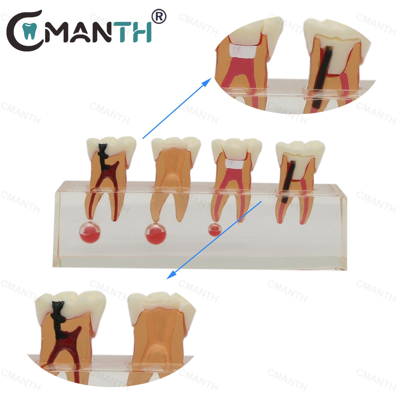 US Dental Teeth Model 4-Stage Molar Root Canal Caries Endodontic Treatment Study