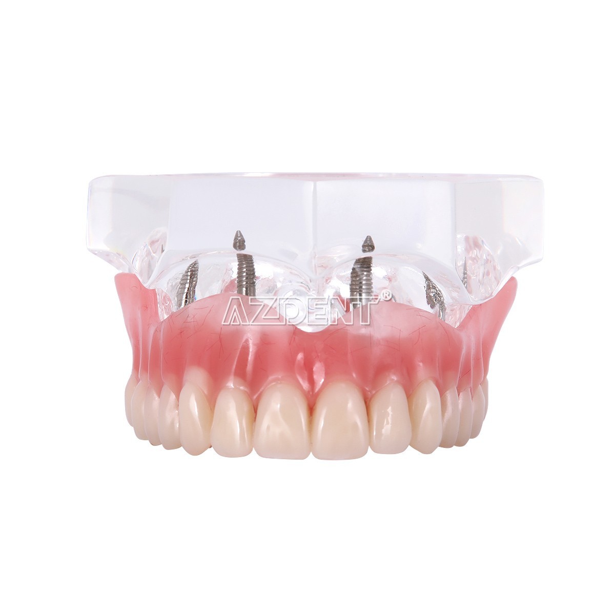 Dental Implant Teeth Model Demo Overdenture Restoration With Implants Lower 6003