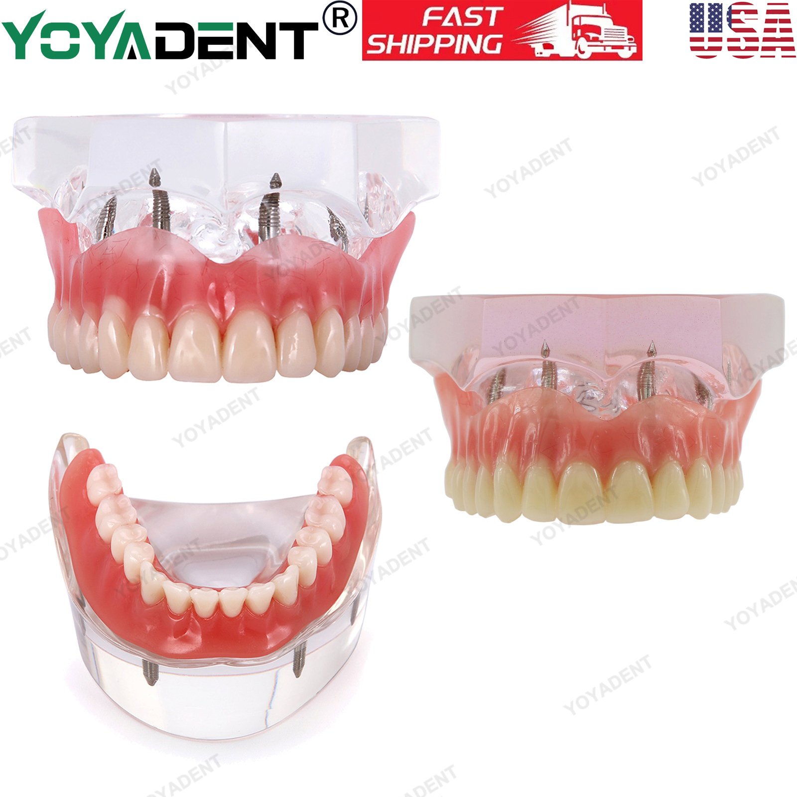 US Dental Implants Teeth Model Upper Lower Jaw 4/6 Overdenture Practice Demo