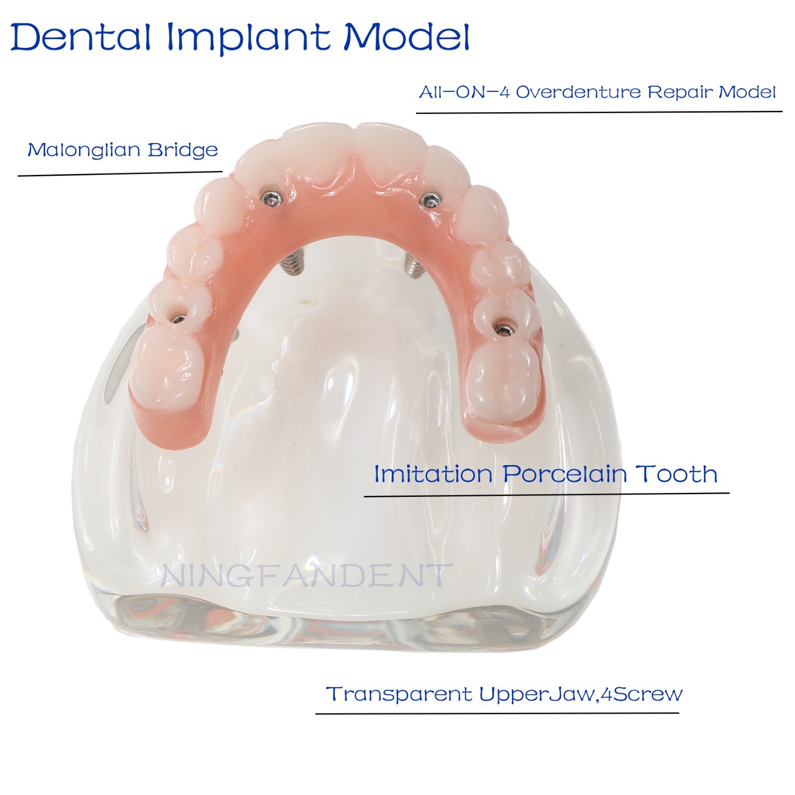 USAll on 4 Dental Implant Model Overdenture Upper Jaw 4 Implant Clear Detachable