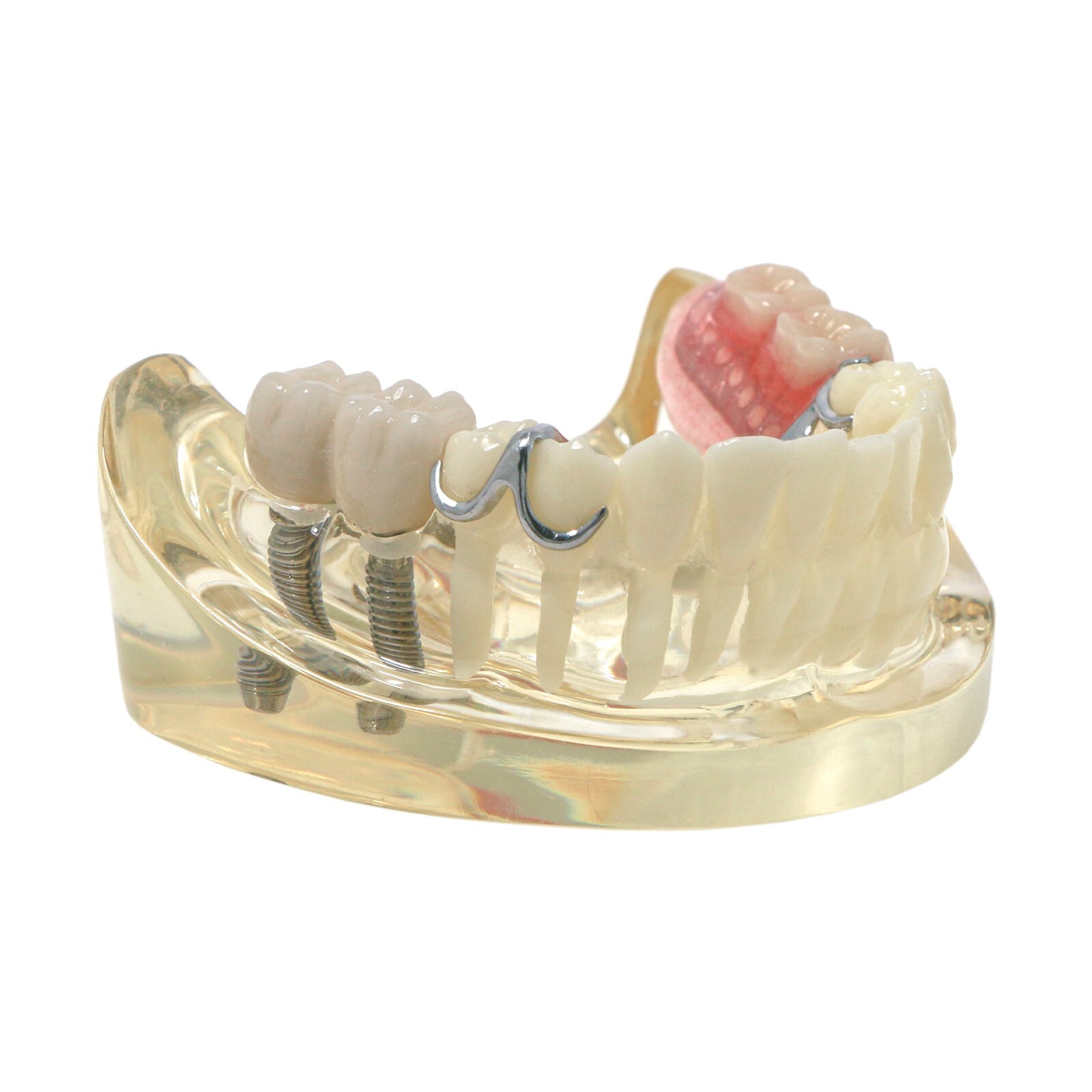 Dental Typodont Teeth Model Implant Pathological Perio Restoration Practice Demo