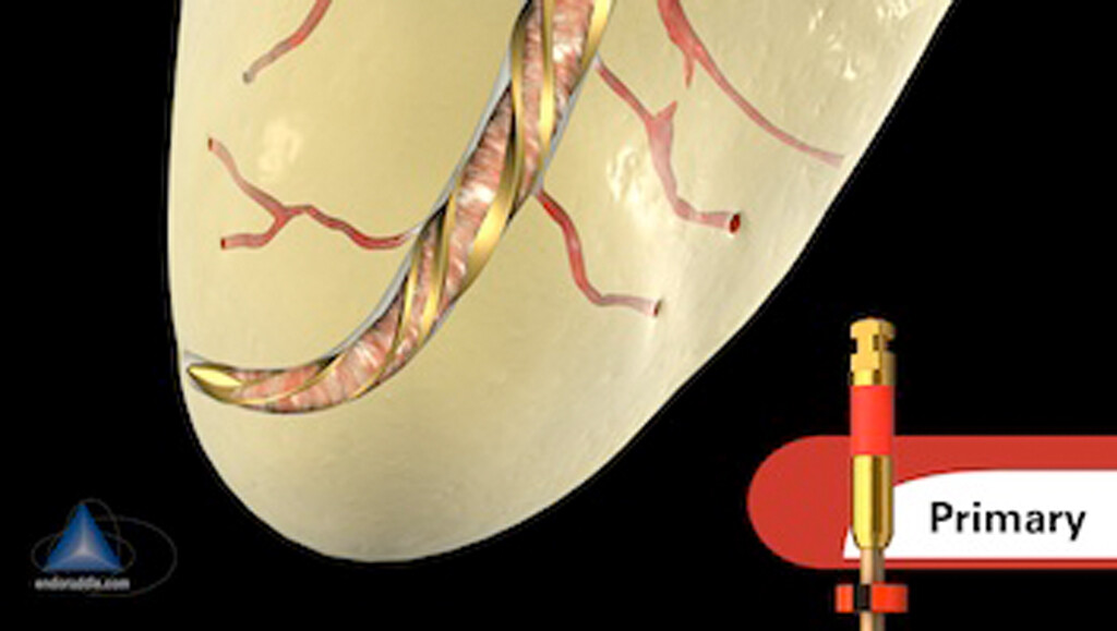 ORIGINAL WaveOne Gold Primary 25mm Endodontic Root Canal 6 Files. READ.