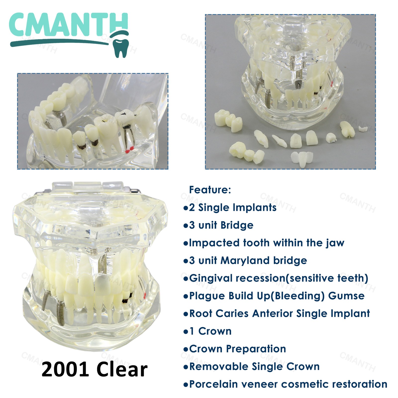 Dental Teeth Model Orthodontic Model Teaching Studying Implant Models Dental Lab