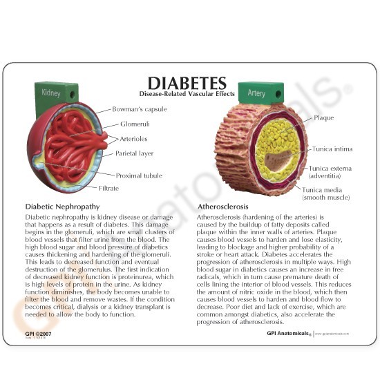 Diabetes 4-pc GPI Anatomical Model Set wKey LFA#4011 Make Us an Offer! SEE VIDEO