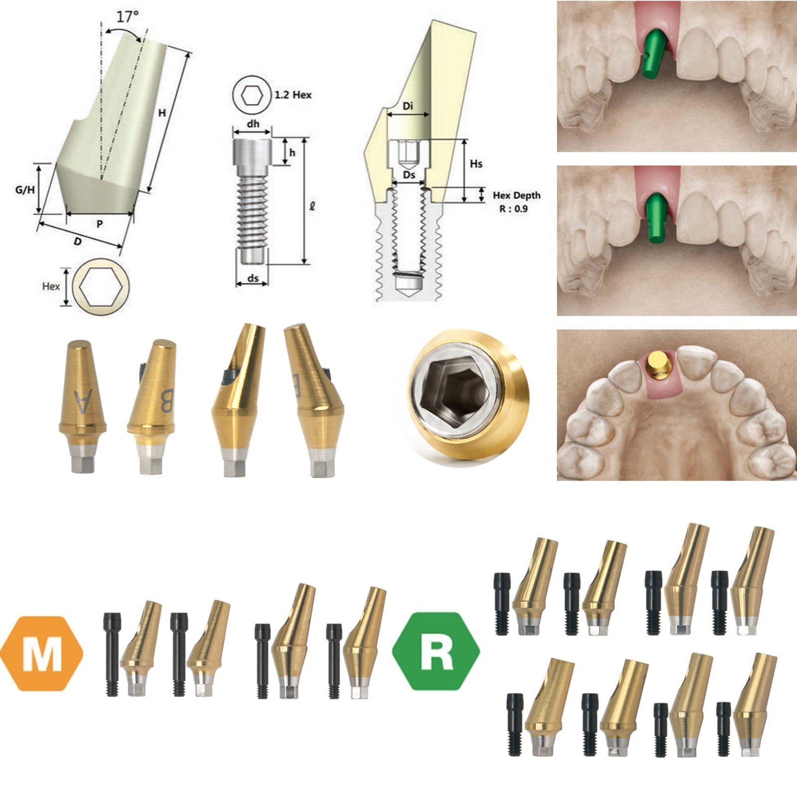 US Dental Prosthetic Abutment Straight & 17° Hex Angled Fit Osstem & Hiossen M/R