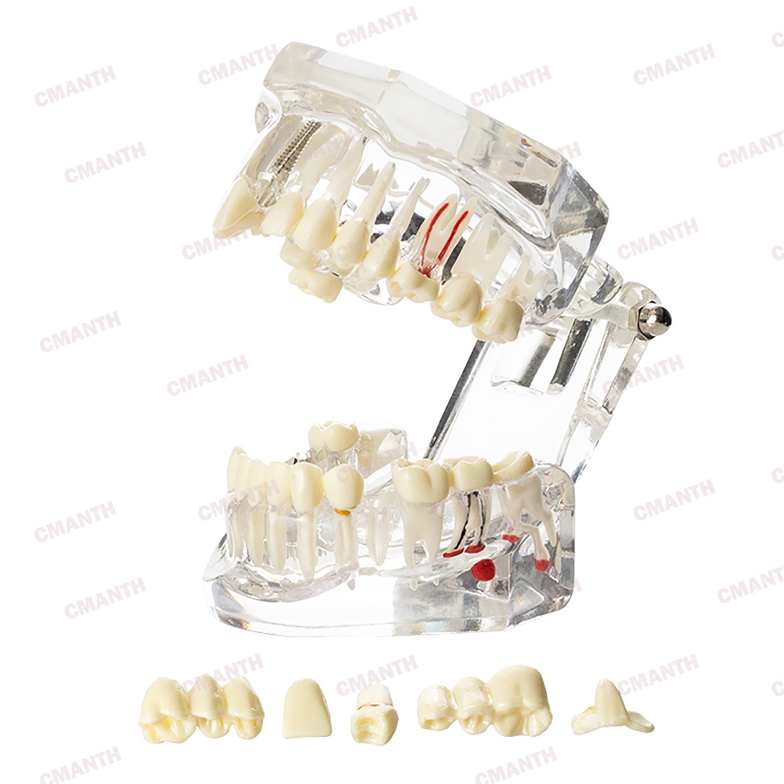 Dental Teeth Model Ortho Implant Practice Teaching of Implants Demo Model