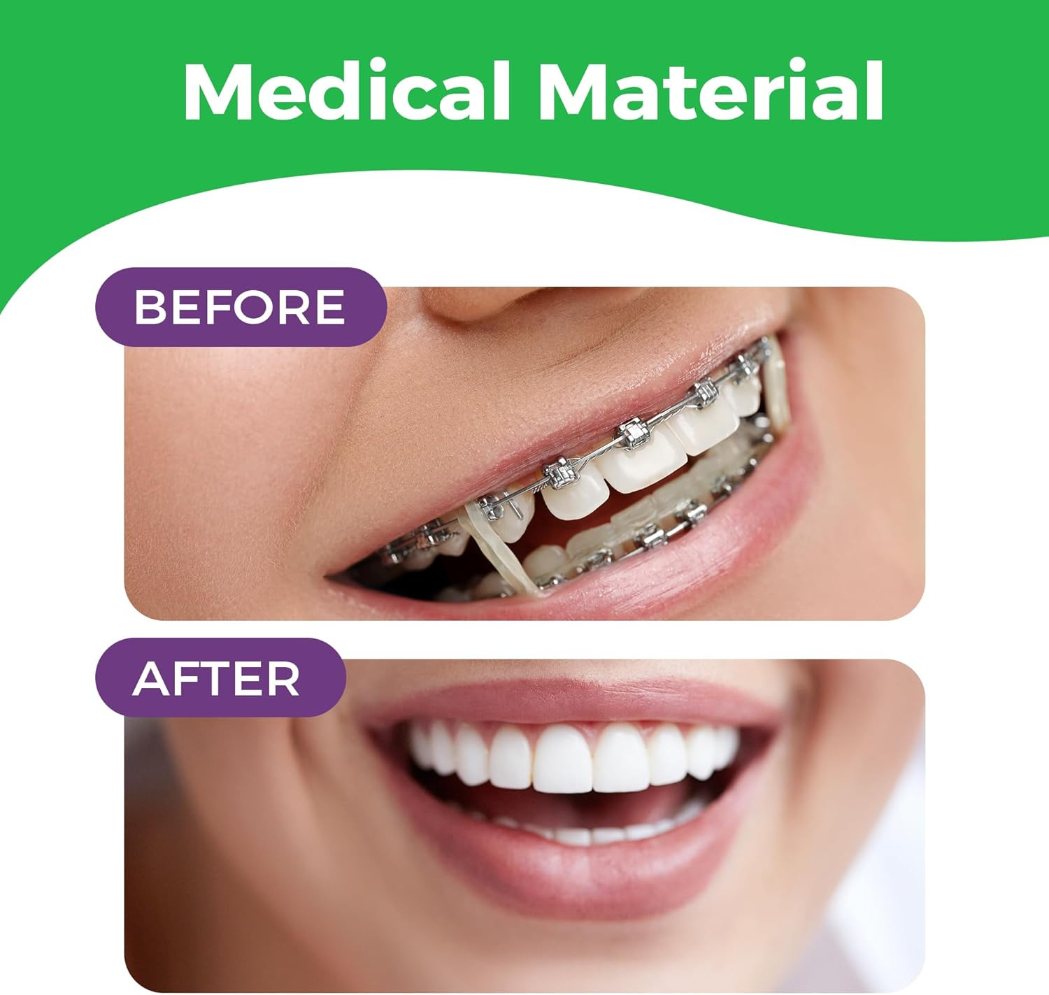 Orthodontic Rubber Bands for Braces – Premium Quality Elastic Teeth Rubber Bands