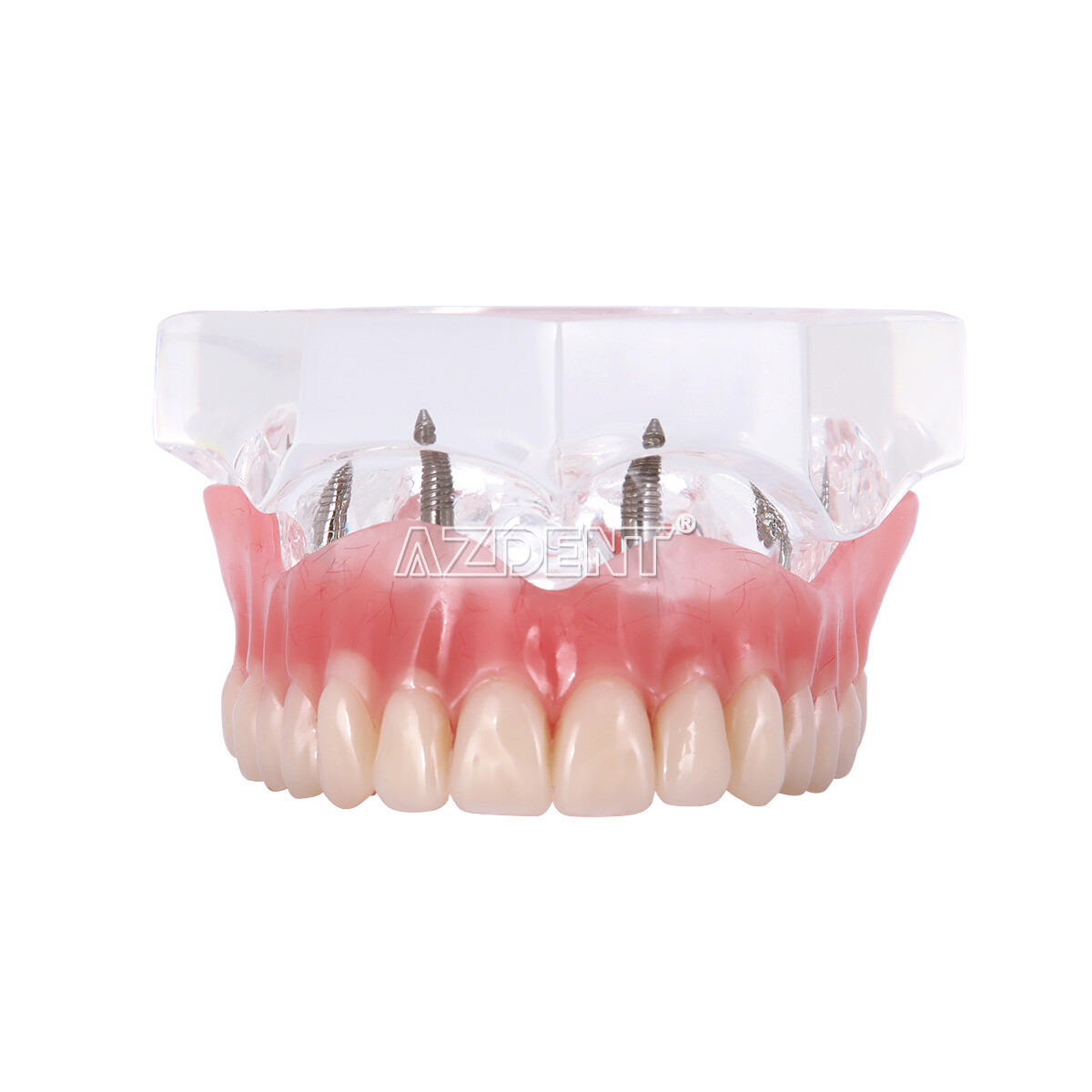 Dental Implant Teeth Model Demo Overdenture Restoration 2 / 4 Implants Upper Low