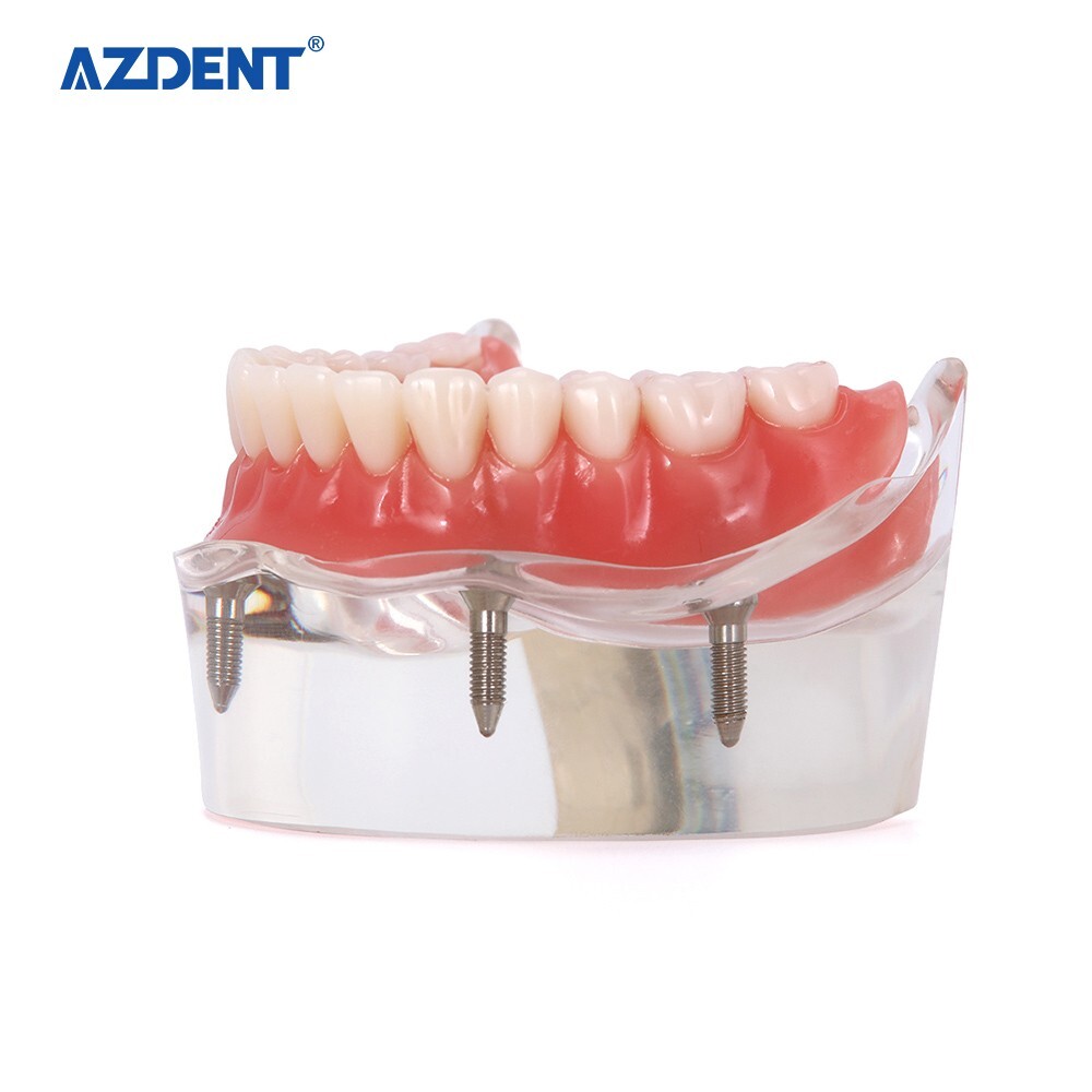 Dental Demonstration 4 Implants Teeth Model Typodont Inferior Overdenture Lower