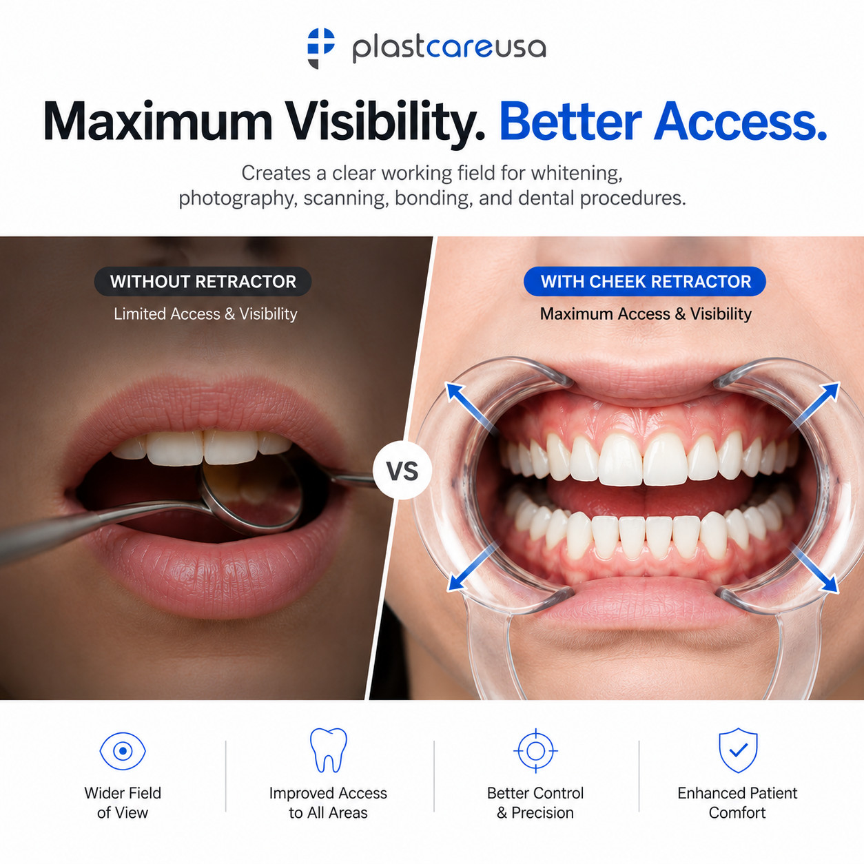 40 Large Teeth Whitening Cheek Retractor, Autoclavable Dental Mouth Opener Game