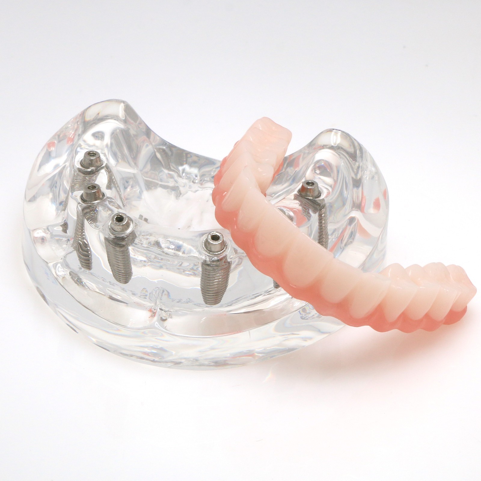 Dental4/6 Implant Overdenture Upper/Lower Model with Detachable Post Core Bridge