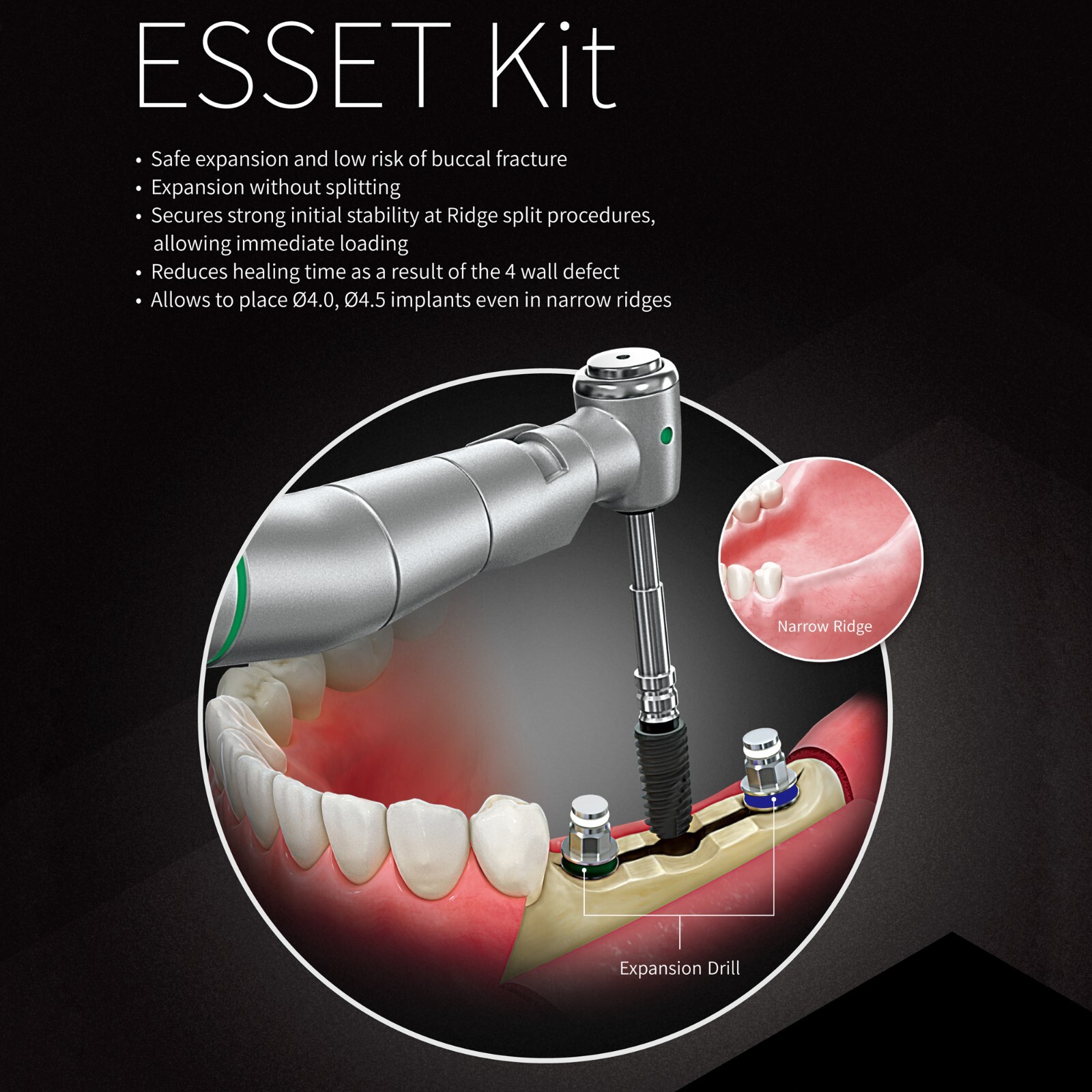 Implant ESSET Kit Easy Split Expansion of the Narrow Ridge HIOSSEN OSSTEM Style