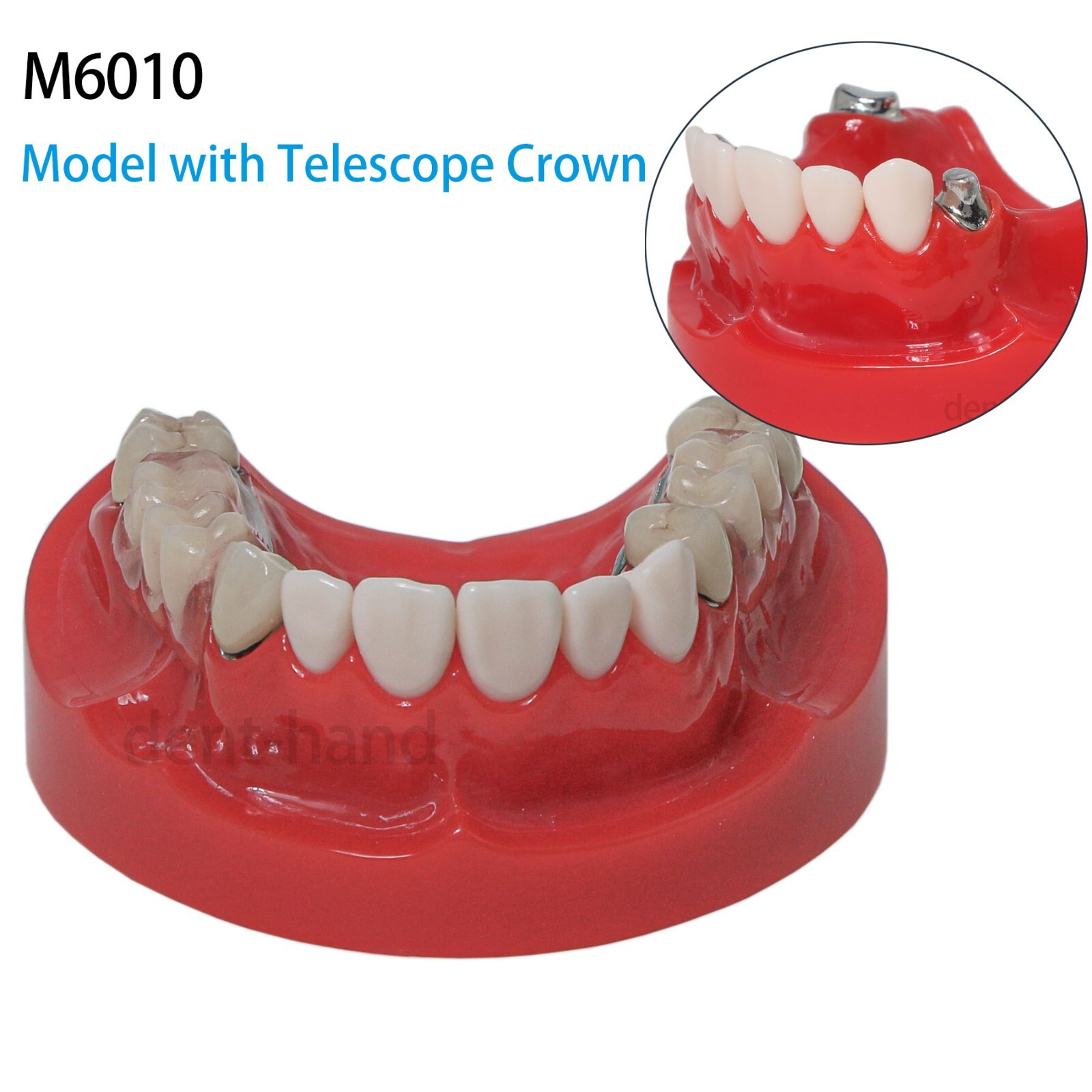 Dental Typhodont Implant Model With Telescope Crown Prosthetics Model M6010