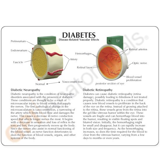 Diabetes 4-pc GPI Anatomical Model Set wKey LFA#4011 Make Us an Offer! SEE VIDEO
