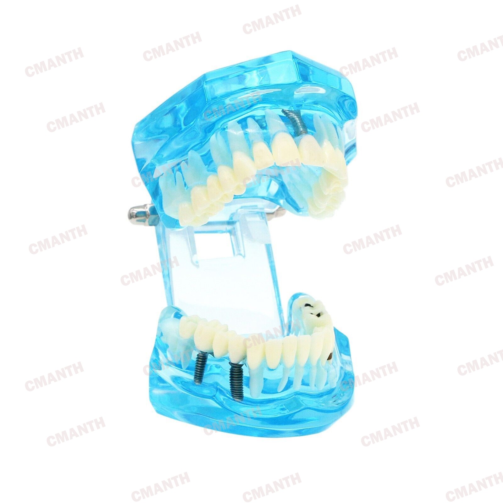 Dental Teeth Model Ortho Implant Practice Teaching of Implants Demo Model
