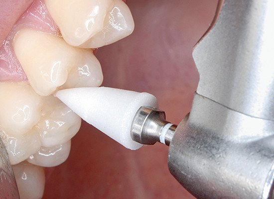 ONEGLOSS IC REFILL #0183