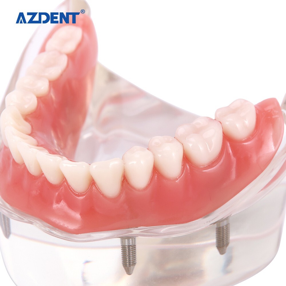 Dental Demonstration 4 Implants Teeth Model Typodont Inferior Overdenture Lower