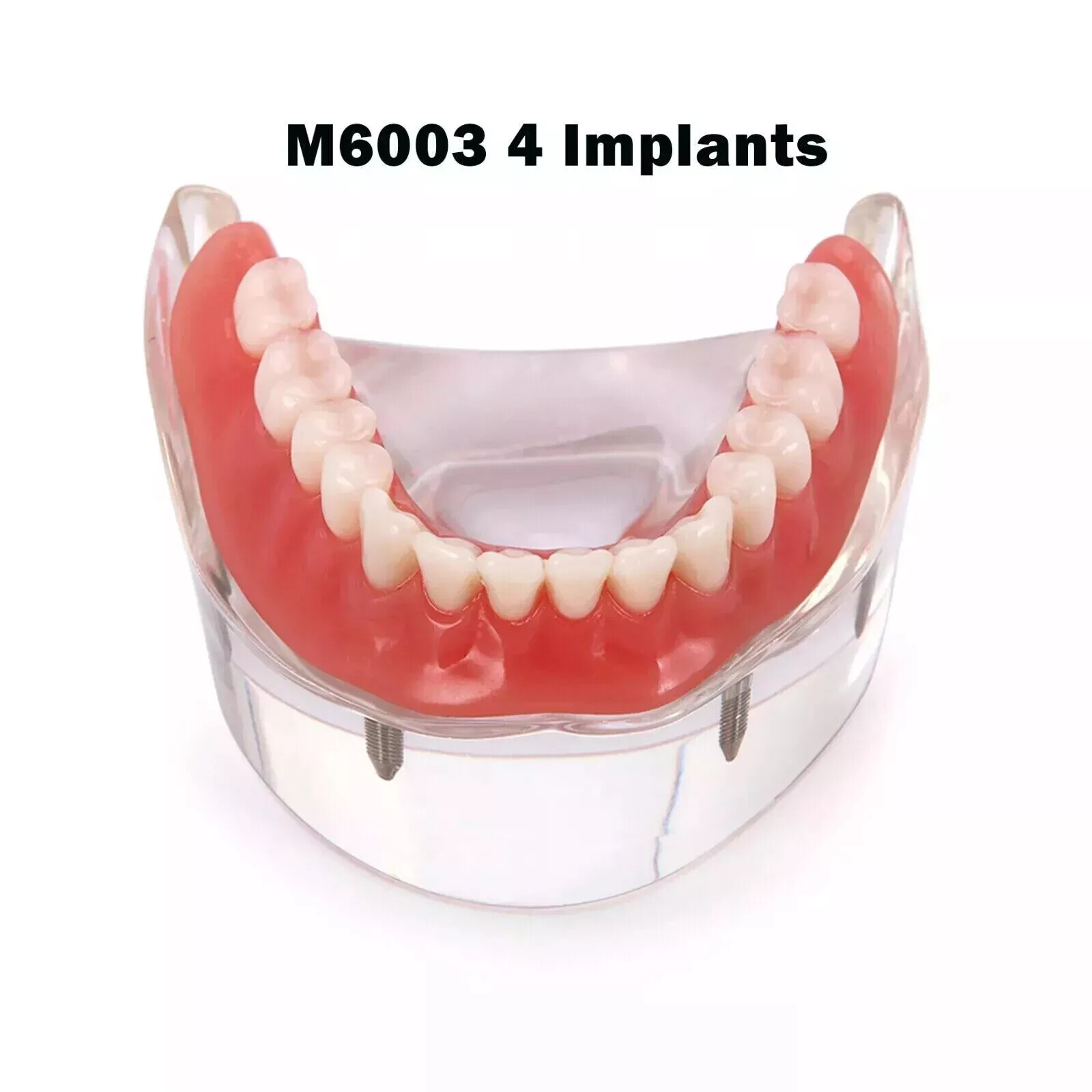 1Pc Dental 4 Implants Lower Overdenture Restoration Implant Typodont Model #6003