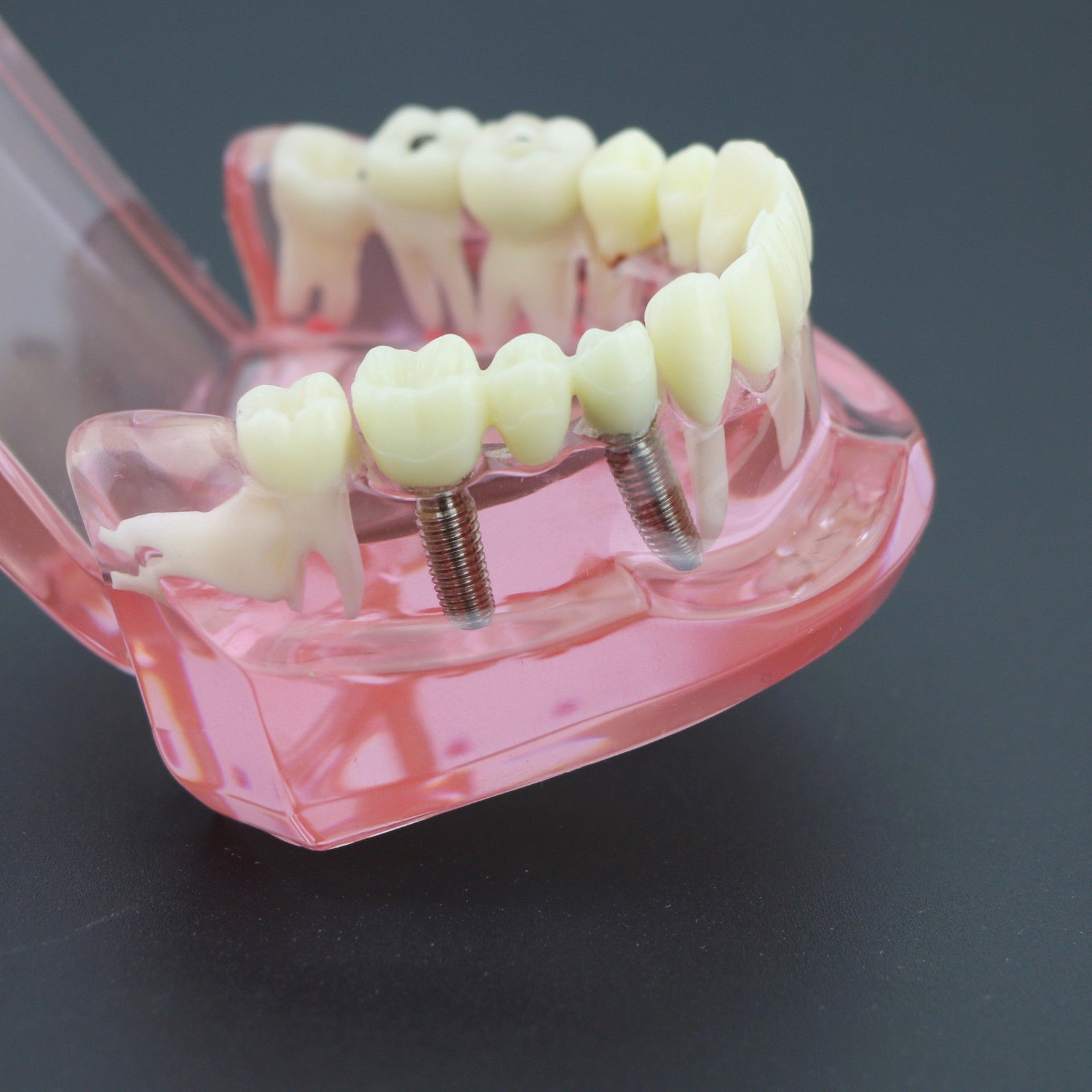 Dental Implant Teeth Model Teach Study Demo Restoration Pathology #2001 Pink