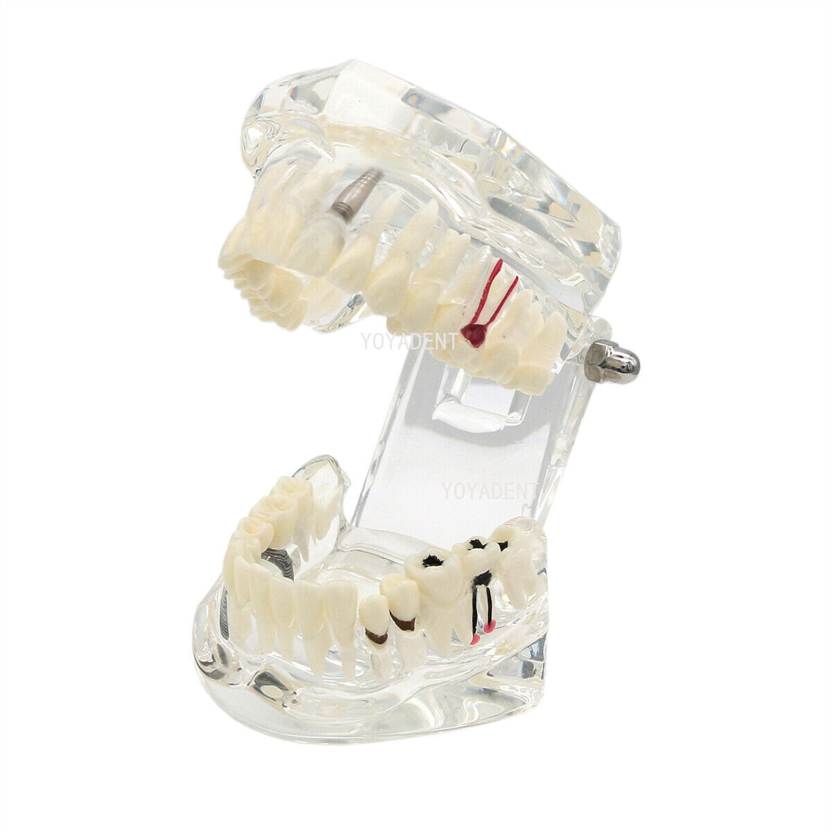 Dental Model Implant Disease Teeth Repair Restoration Bridge Dentist Teaching