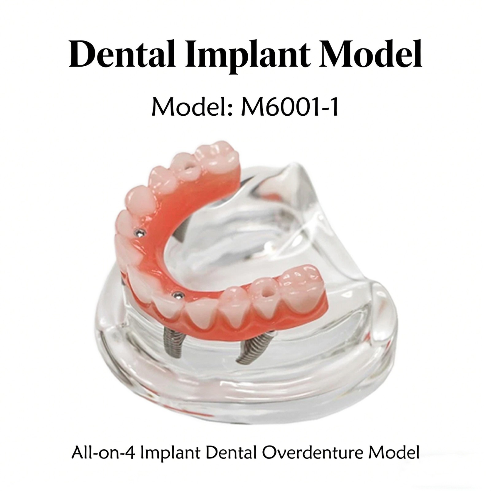 Dental All-on-4 Overdenture Implant Model,Treatment Upper Jaw-Clear,With 4 Screw