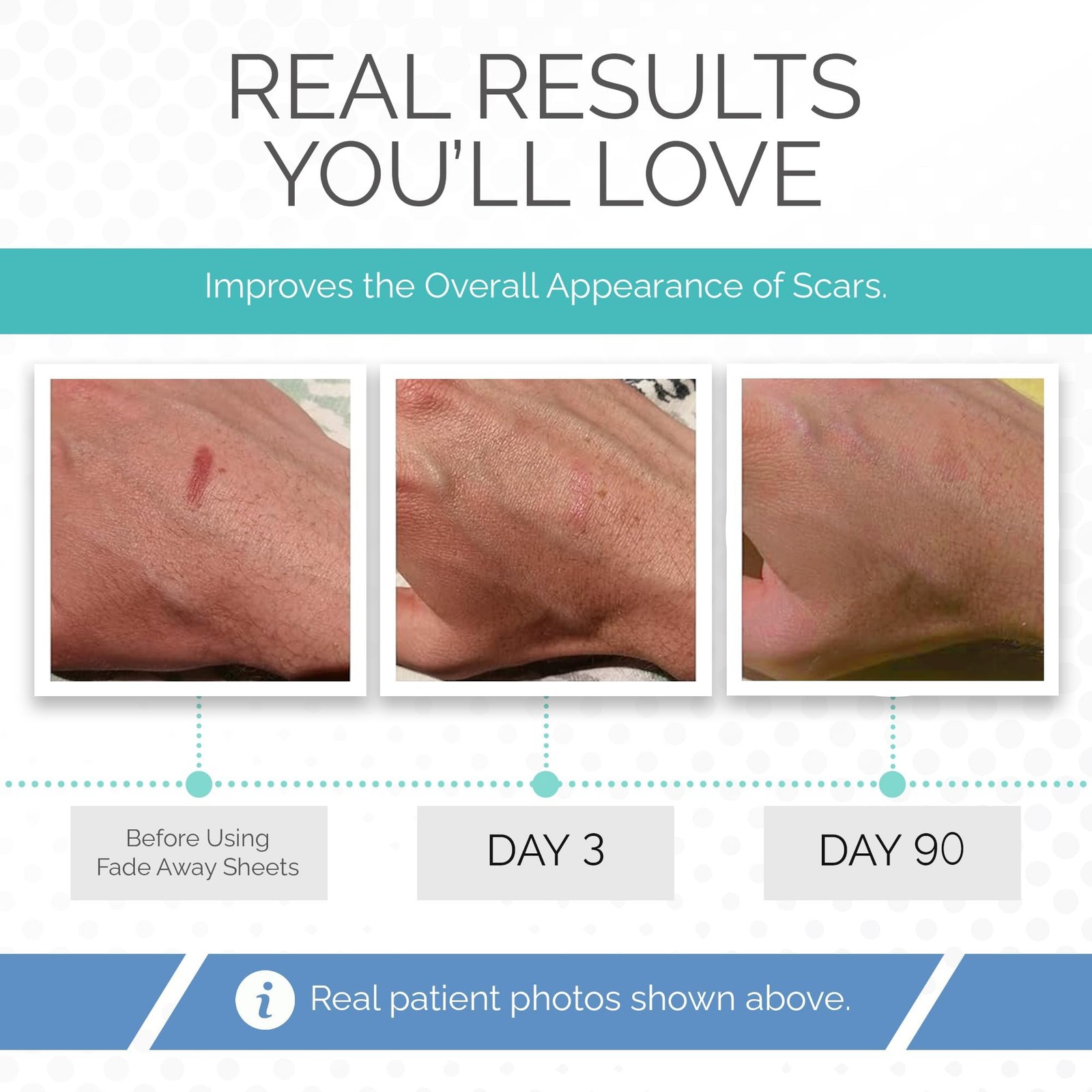 Fade Away Clinically Proven Silicone Scar Sheets Medical Grade Tape For Surgery