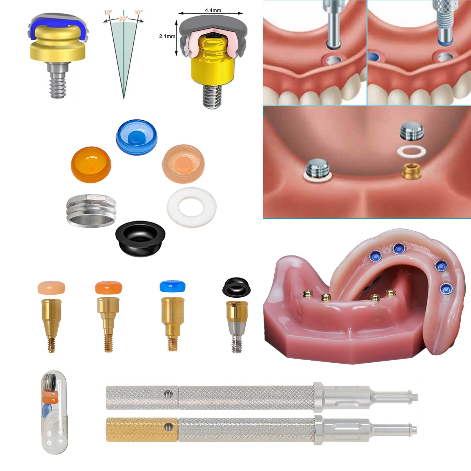 US Locator Tapered Overdenture Abutment Fit Hiossen/NobelActive /Zimmer/Adin/MIS