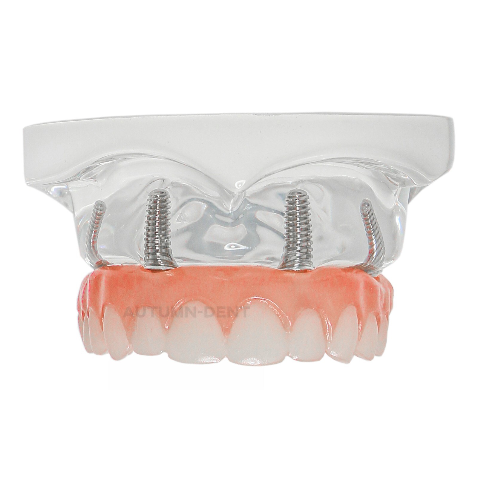 Dental All on 4 Overdenture Transparent Upper Lower Jaw Type Model With 4 Screws
