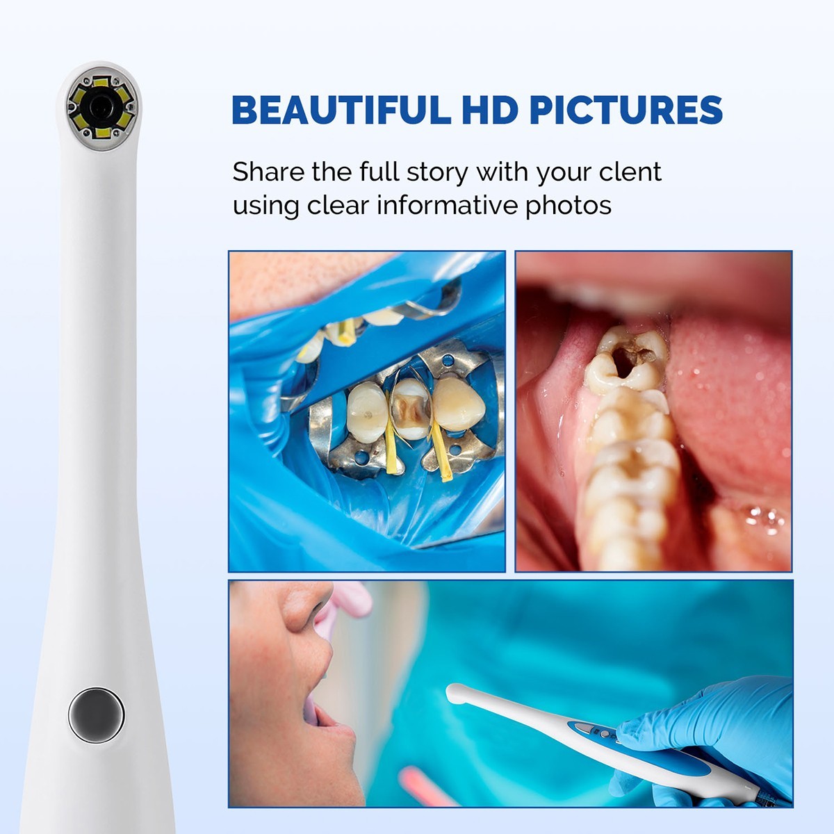 5pcs Dental High Speed Diamond Burs Orthodontic Interproximal Enamel Set
