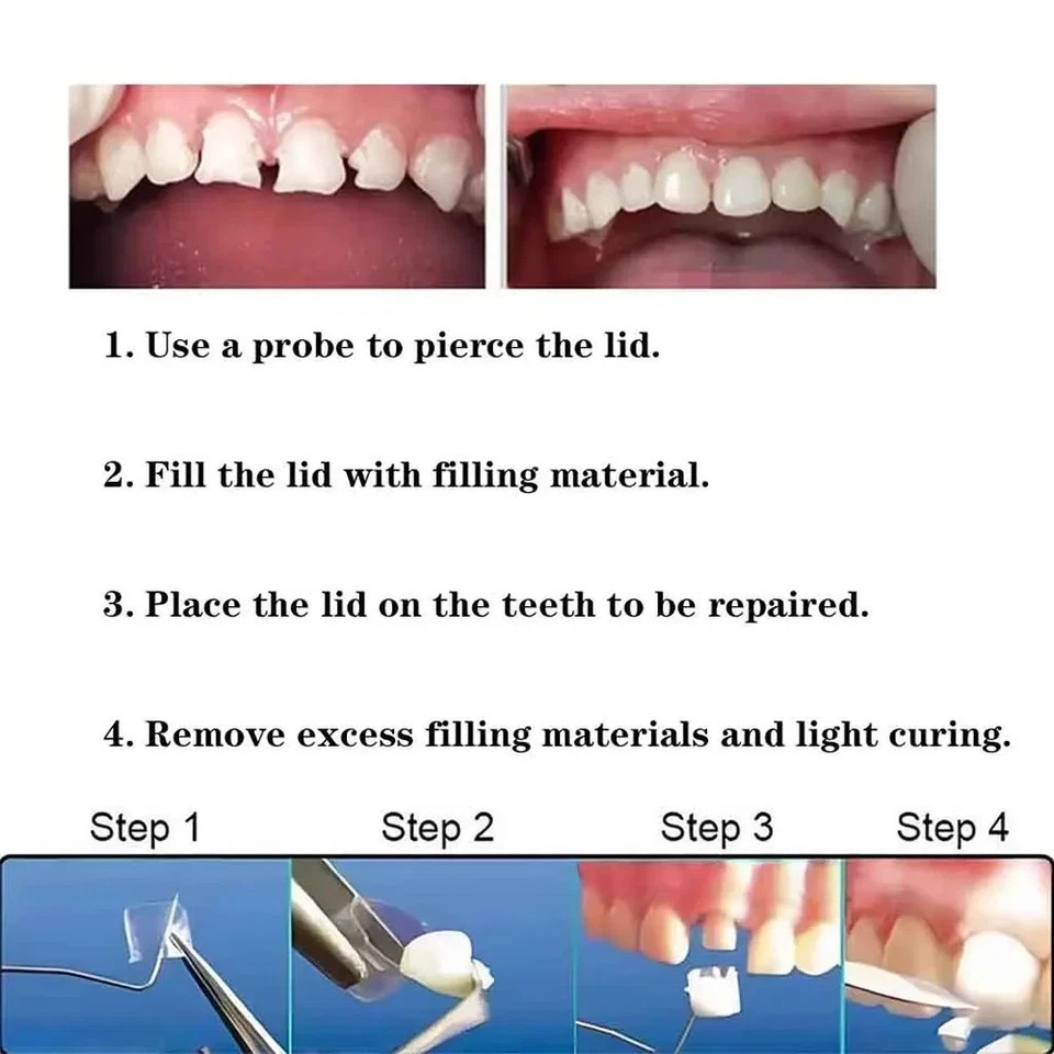 Dental Preformed Crown Resin Temporary Pre-corona Transparent Anterior 1.910