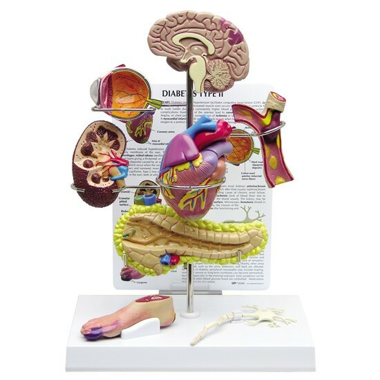 DiabetesType II Organ Model Set GPI Anatomy LFA#4010 Make Us an Offer! SEE VIDEO