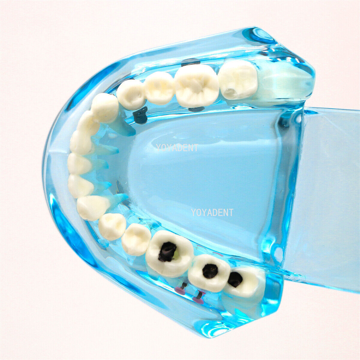 Dental Model Implant Disease Teeth Repair Restoration Bridge Dentist Teaching