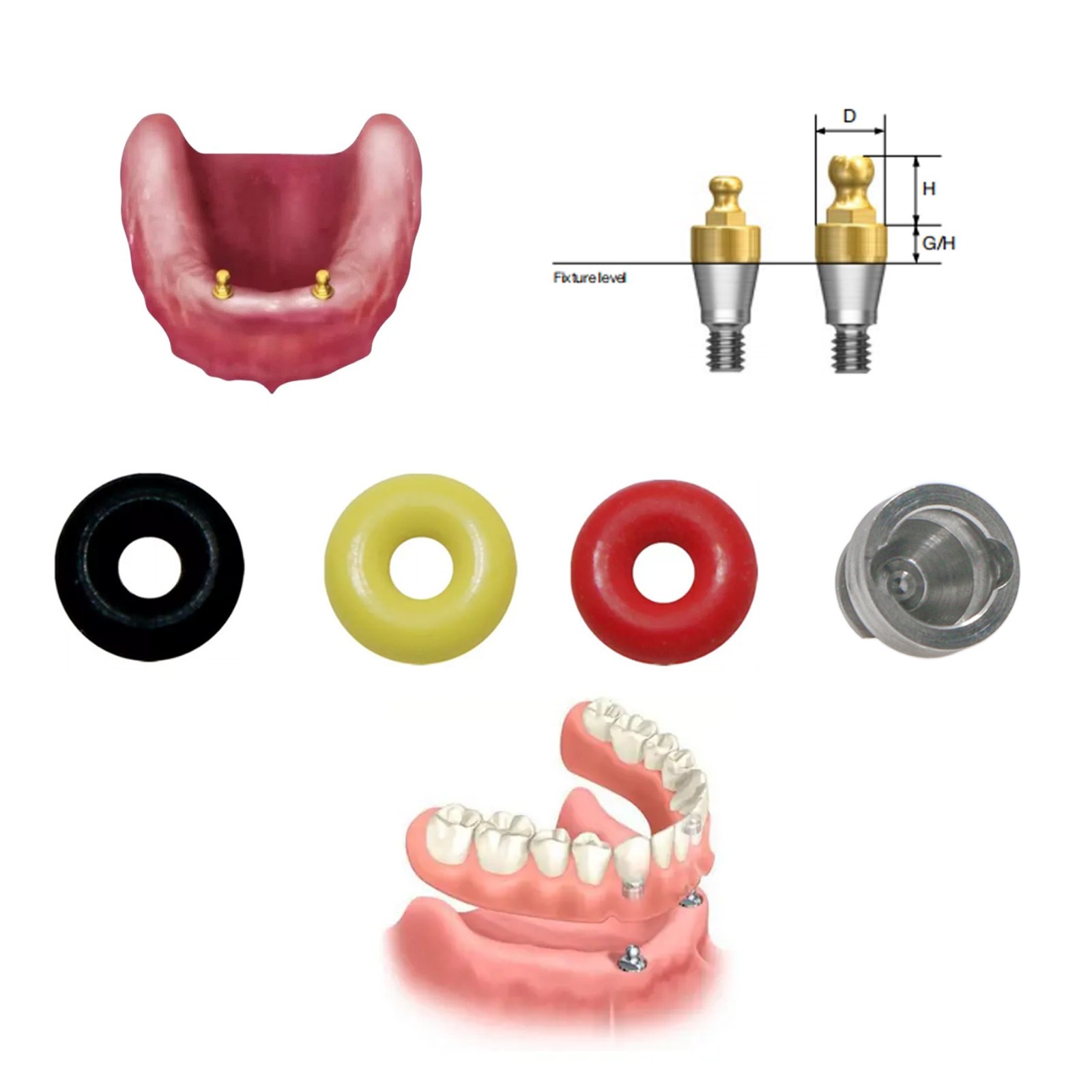 Dental Fit Hiossen/Osstem Implants Compatible Ball Abutment O-Ring Retention Cap