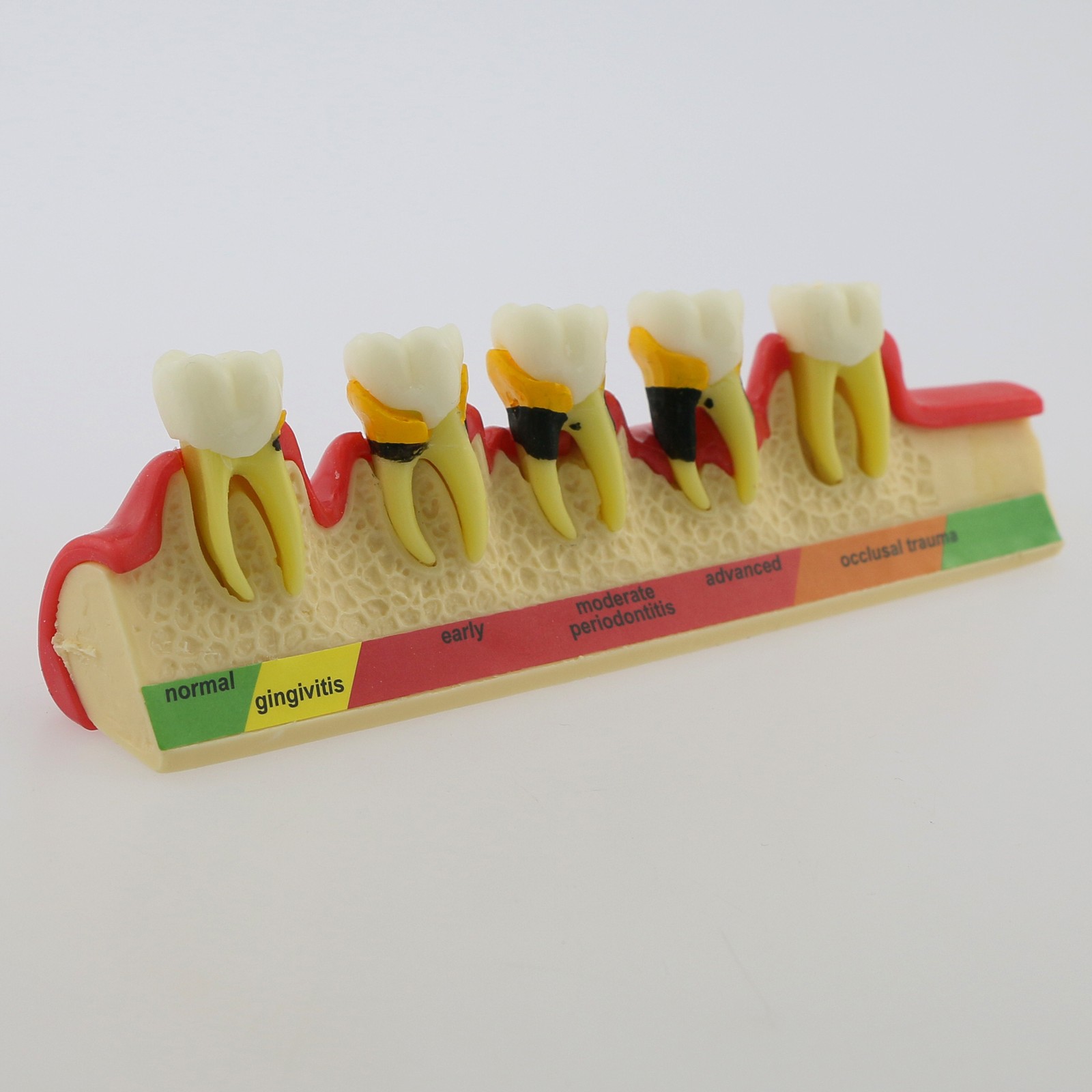 Dental Pathological Model 5 Stage Periodontal Disease Patient Communication Demo