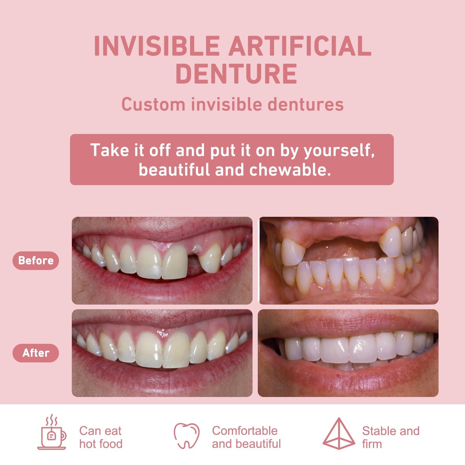 Custom Partial Dentures – Personalized Removable Denture Set for Missing T