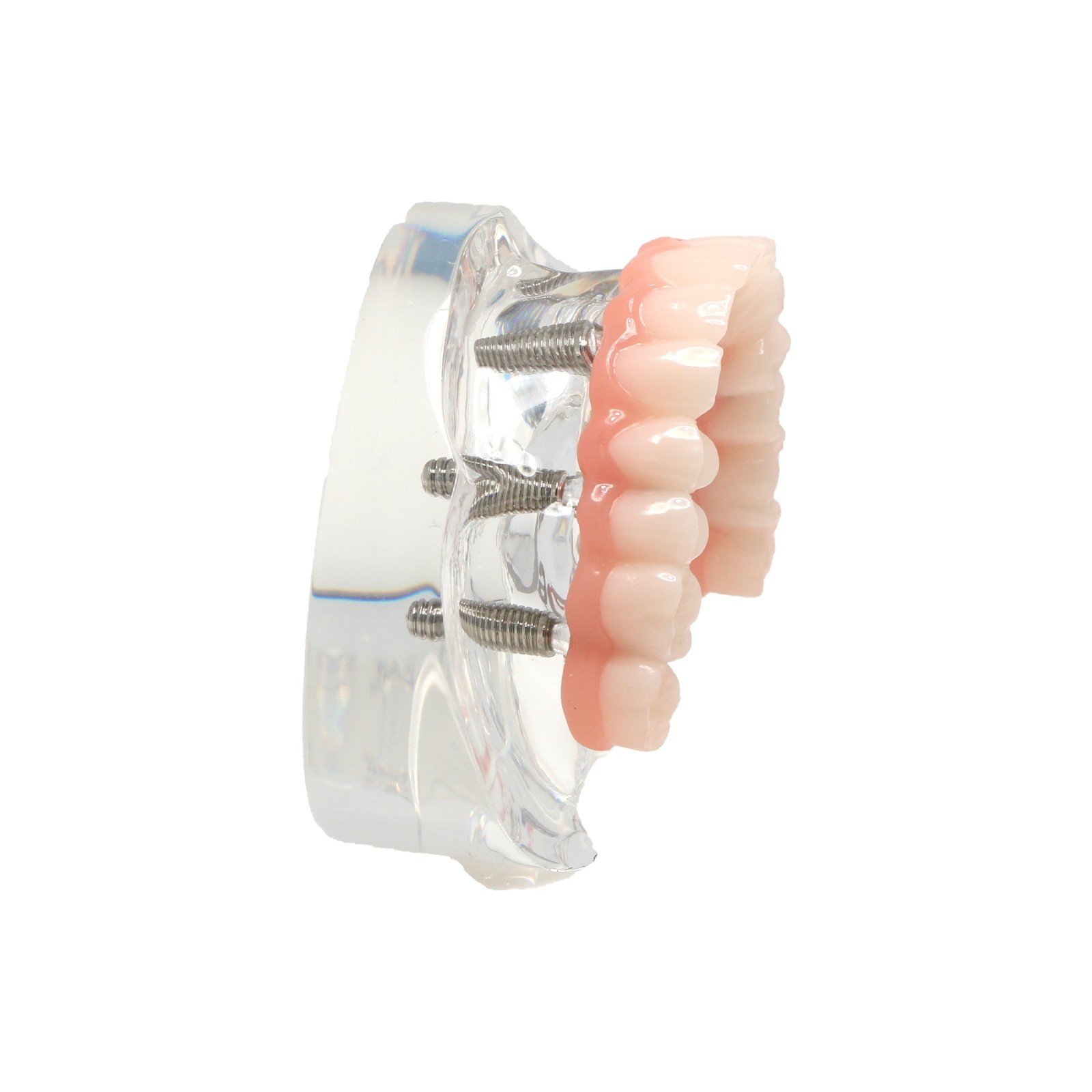 Dental4/6 Implant Overdenture Upper/Lower Model with Detachable Post Core Bridge