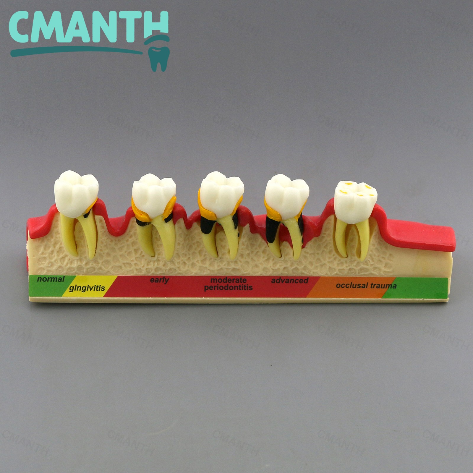 Dental Pathological Model 5 Stage Periodontal Disease Patient Communication Demo