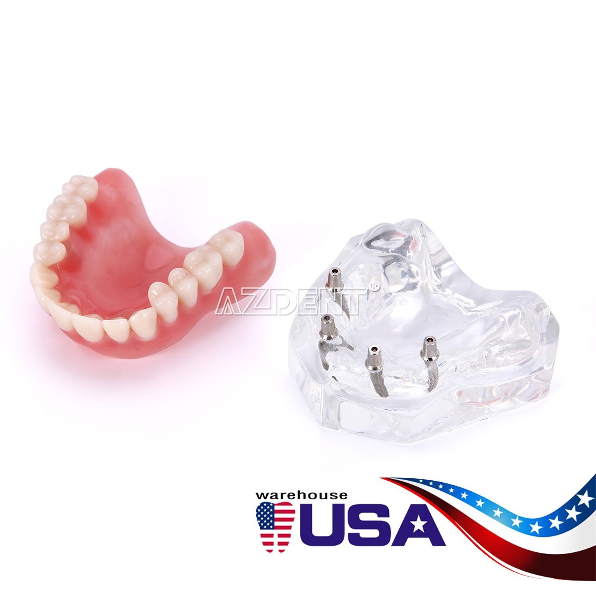 Dental Implant Teeth Model Demo Overdenture Restoration With Implants Lower 6003