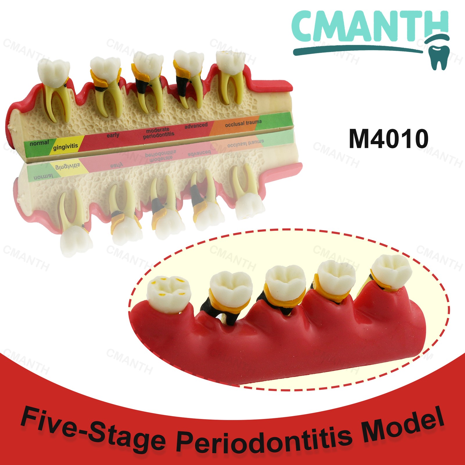 Dental Pathological Model 5 Stage Periodontal Disease Patient Communication Demo