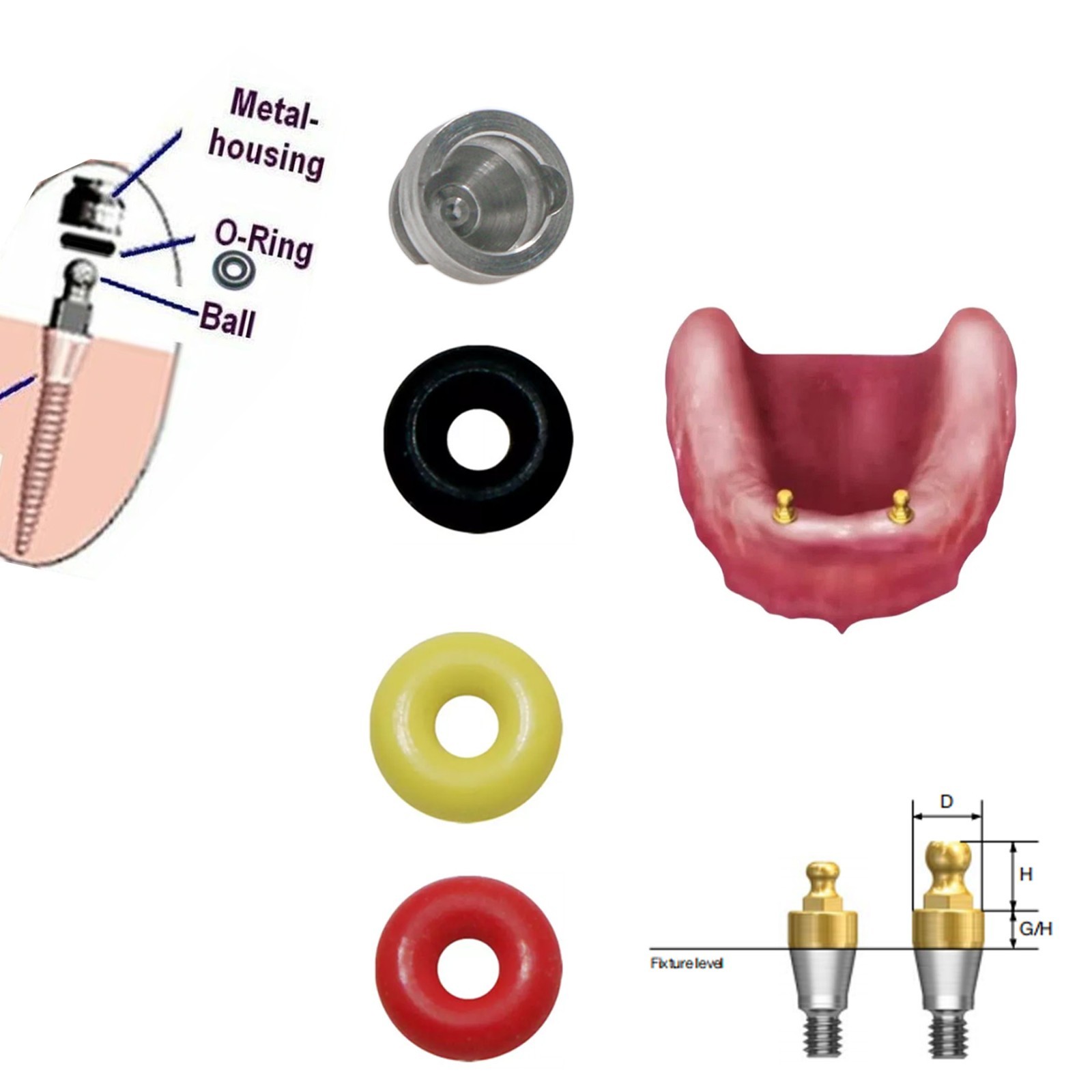 Dental Fit Hiossen/Osstem Implants Compatible Ball Abutment O-Ring Retention Cap