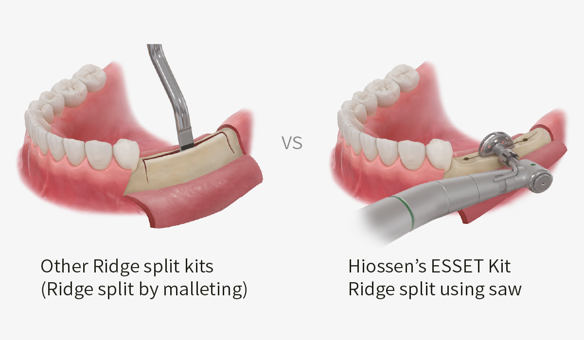 Dental Implant ESSET Kit Easy Split & Expansion of Narrow Ridge HIOSSEN OSSTEM
